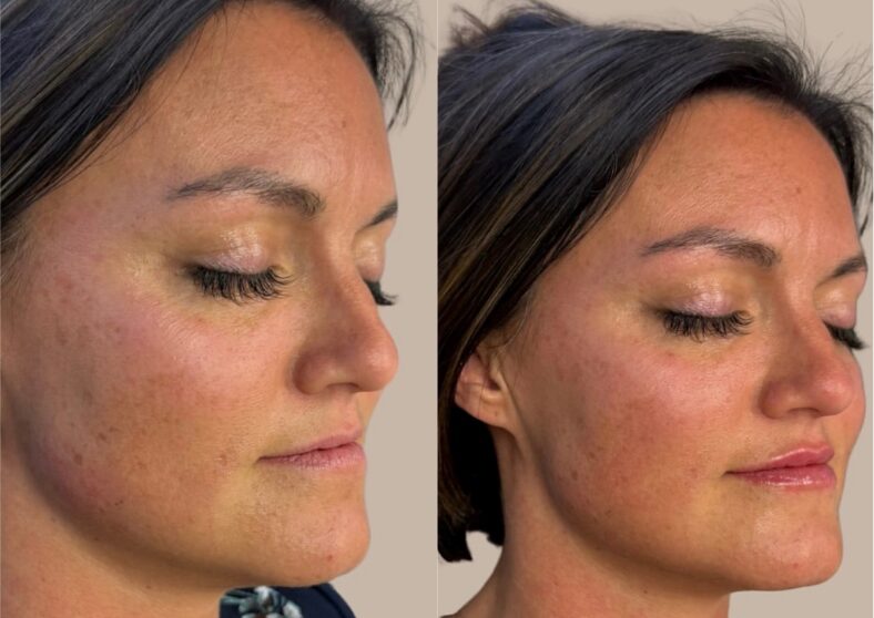 Before and after dermal filler at Integrated Spa