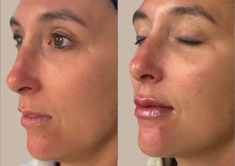 Before and after lip filler at Integrated Spa